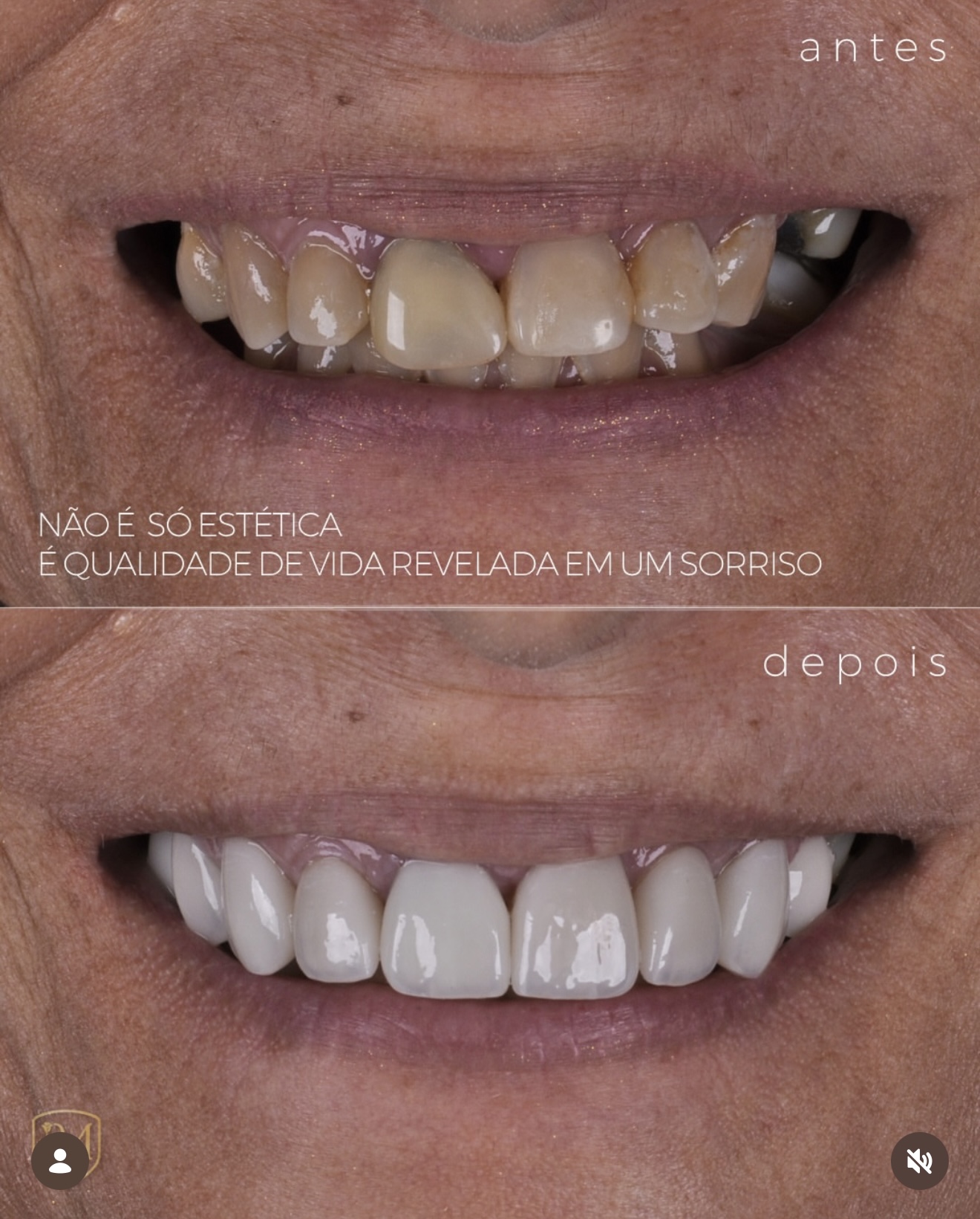 Caso clínico 4 — antes e depois